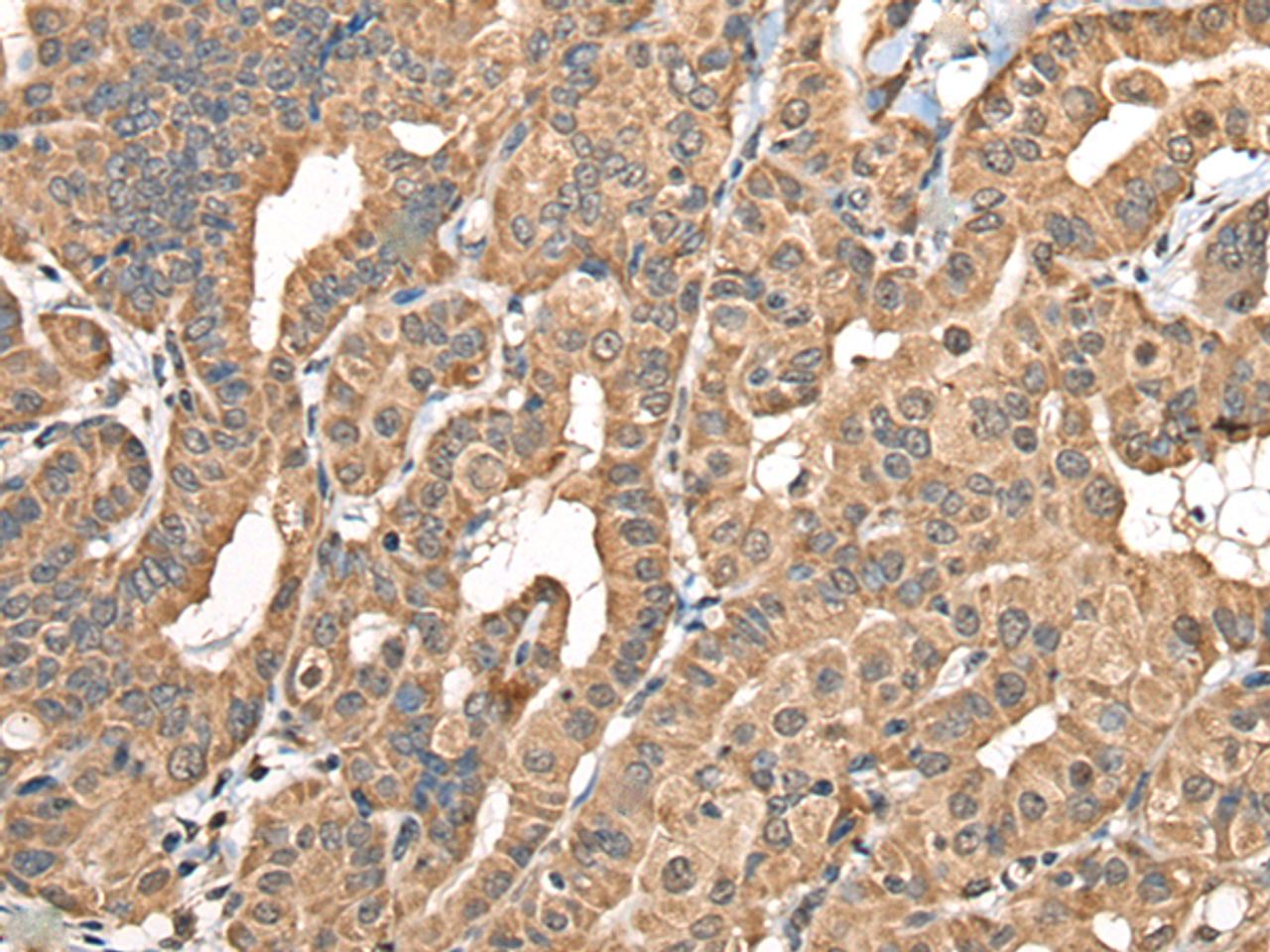 Immunohistochemistry of paraffin-embedded Human thyroid cancer tissue  using NADK2 Polyclonal Antibody at dilution of 1:40(×200)