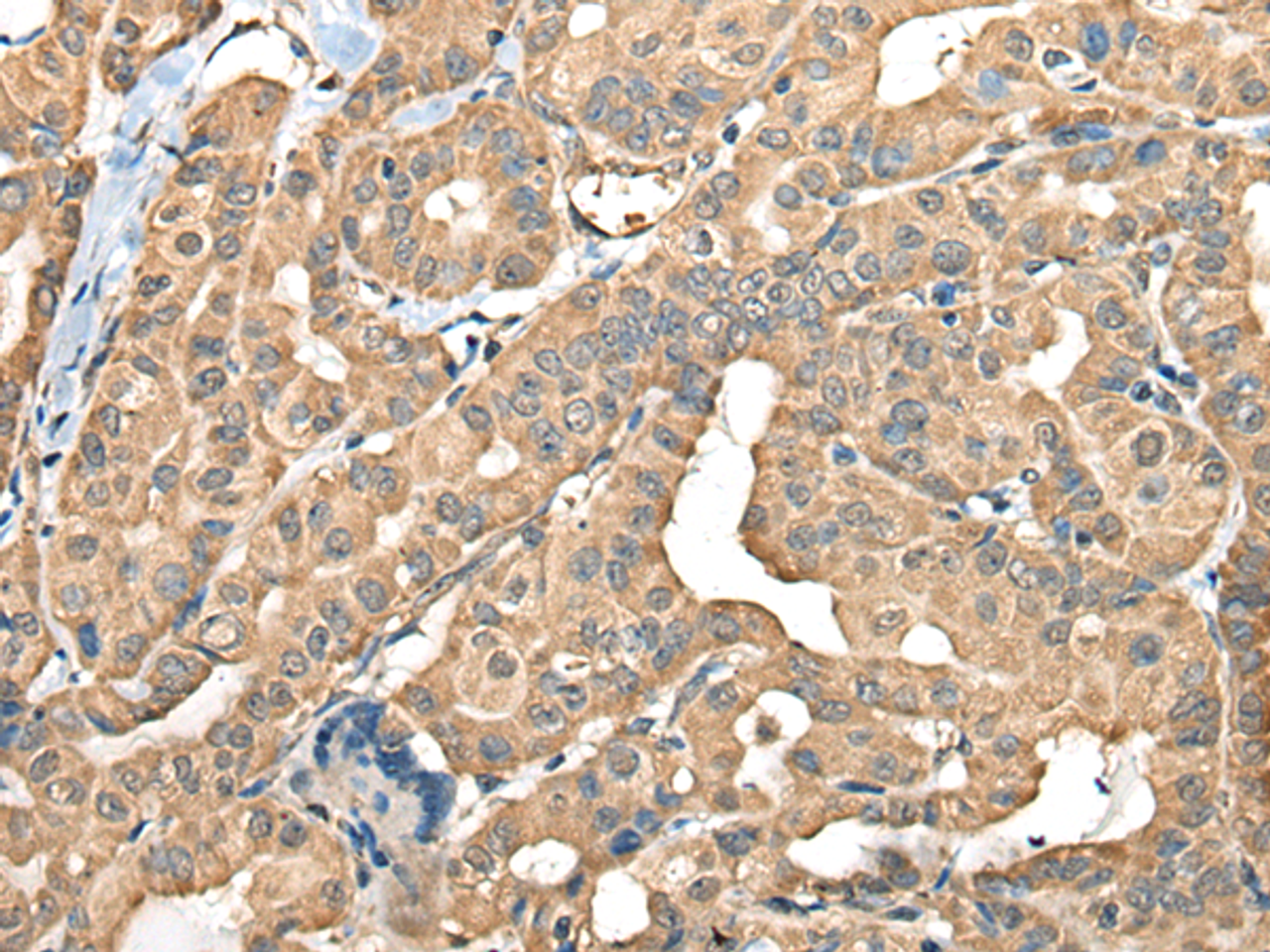 Immunohistochemistry of paraffin-embedded Human thyroid cancer tissue  using FAM110B Polyclonal Antibody at dilution of 1:40(×200)