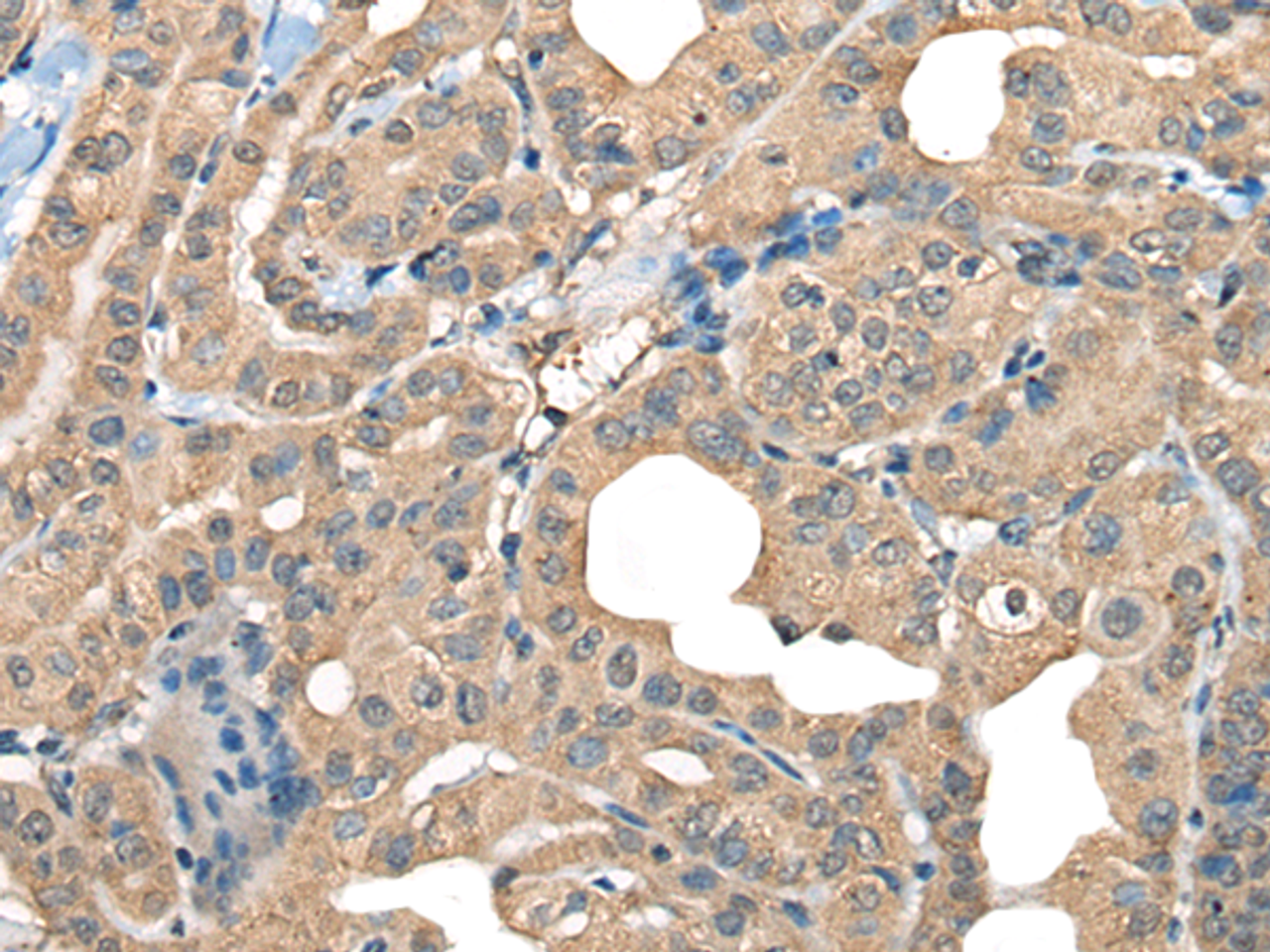 Immunohistochemistry of paraffin-embedded Human thyroid cancer tissue  using CABP5 Polyclonal Antibody at dilution of 1:65(×200)