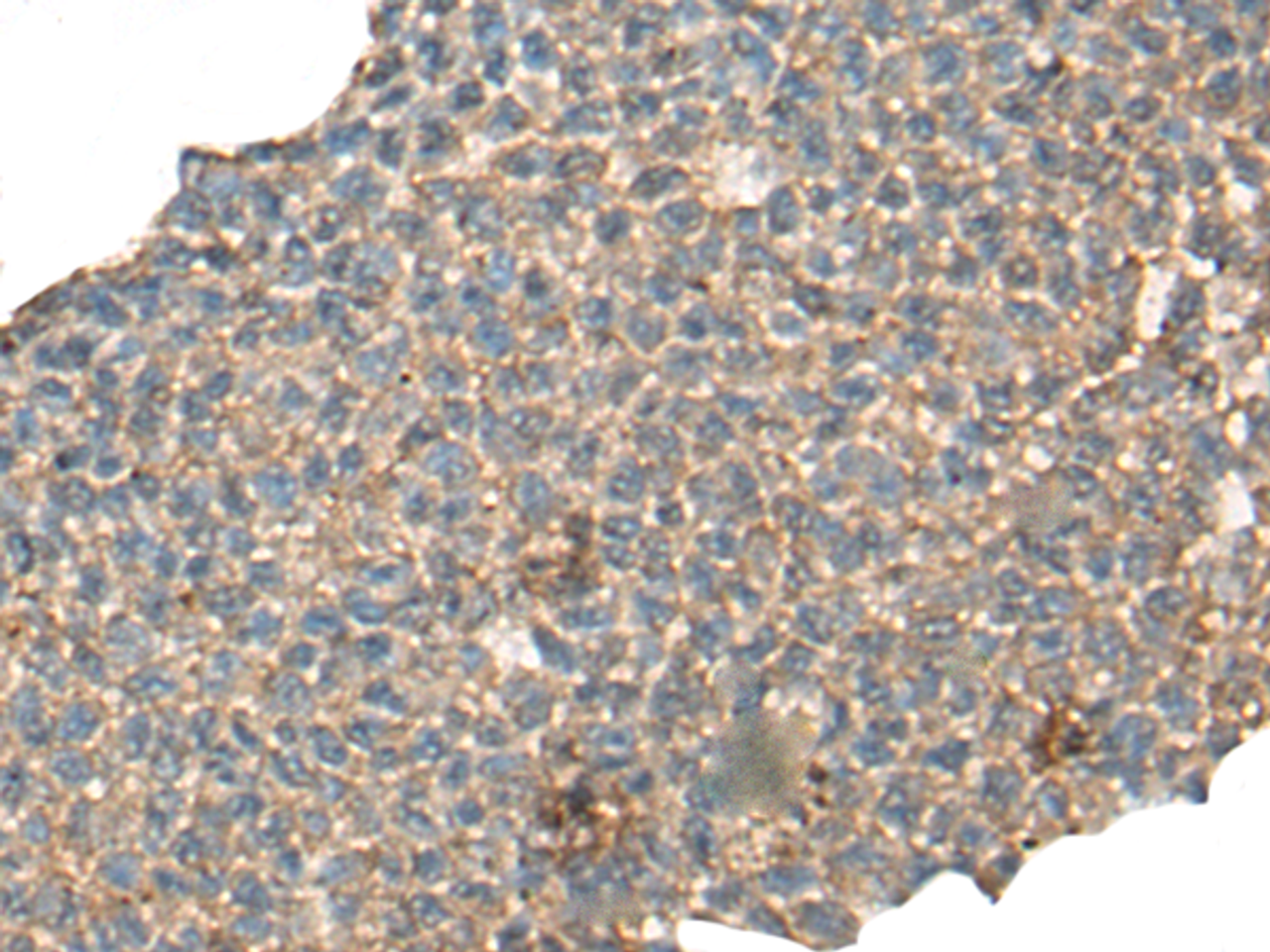 Immunohistochemistry of paraffin-embedded Human ovarian cancer tissue  using CABP5 Polyclonal Antibody at dilution of 1:65(×200)