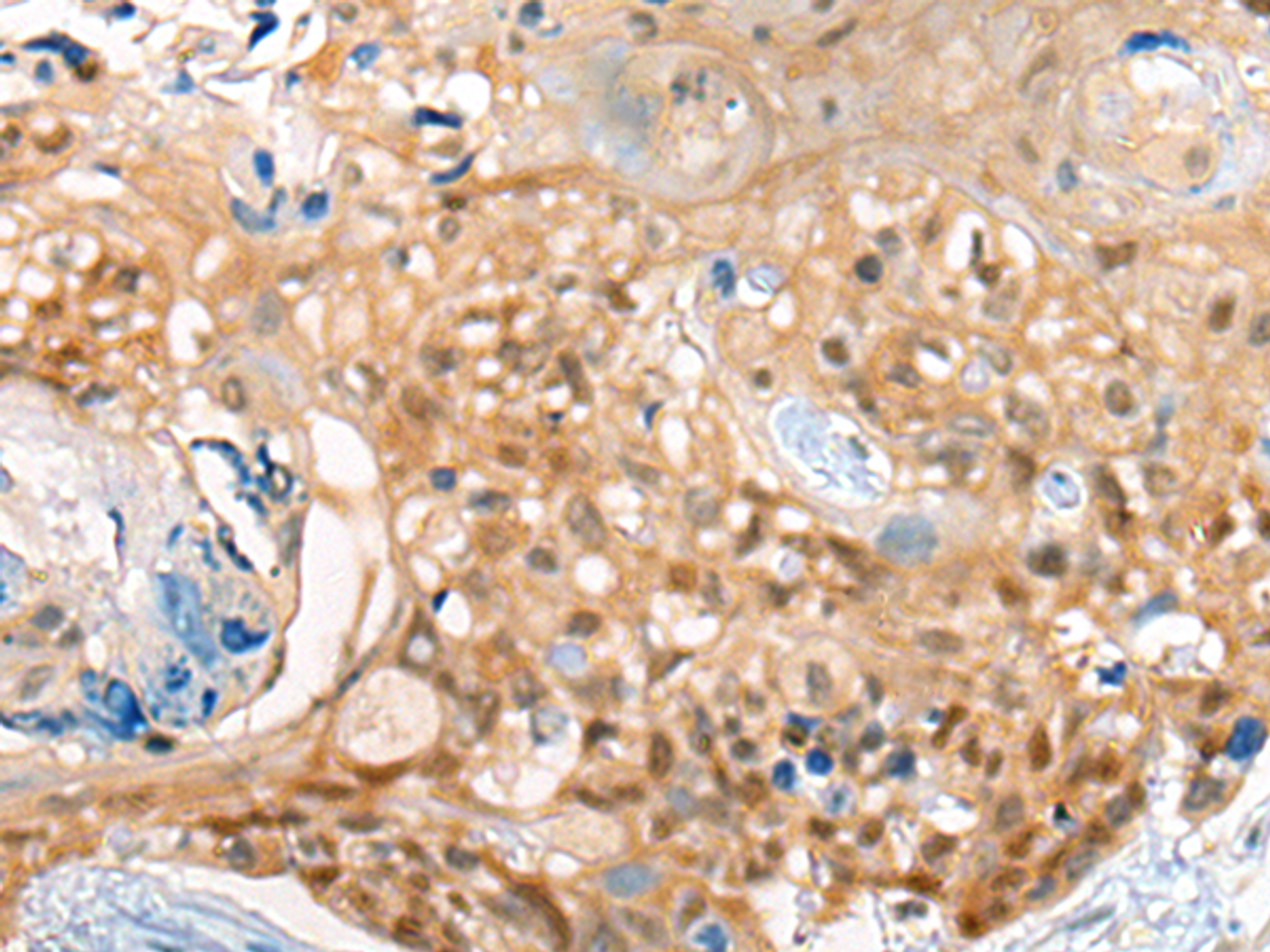 Immunohistochemistry of paraffin-embedded Human esophagus cancer tissue  using CBR3 Polyclonal Antibody at dilution of 1:35(×200)