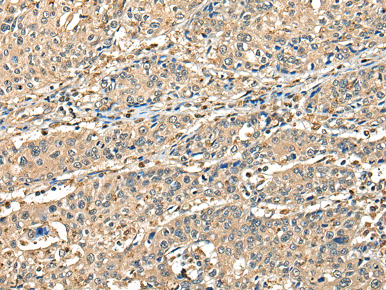 Immunohistochemistry of paraffin-embedded Human prost at e cancer tissue  using CCDC112 Polyclonal Antibody at dilution of 1:45(×200)