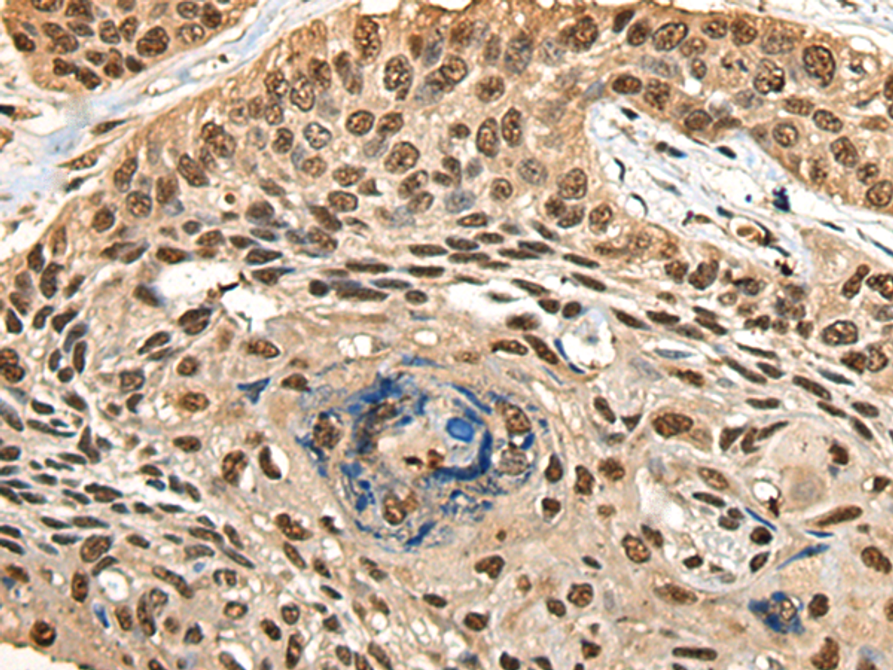 Immunohistochemistry of paraffin-embedded Human esophagus cancer tissue  using CCDC112 Polyclonal Antibody at dilution of 1:45(×200)