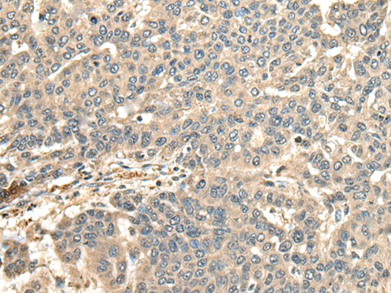 Immunohistochemistry of paraffin-embedded Human liver cancer tissue  using CCDC113 Polyclonal Antibody at dilution of 1:65(×200)