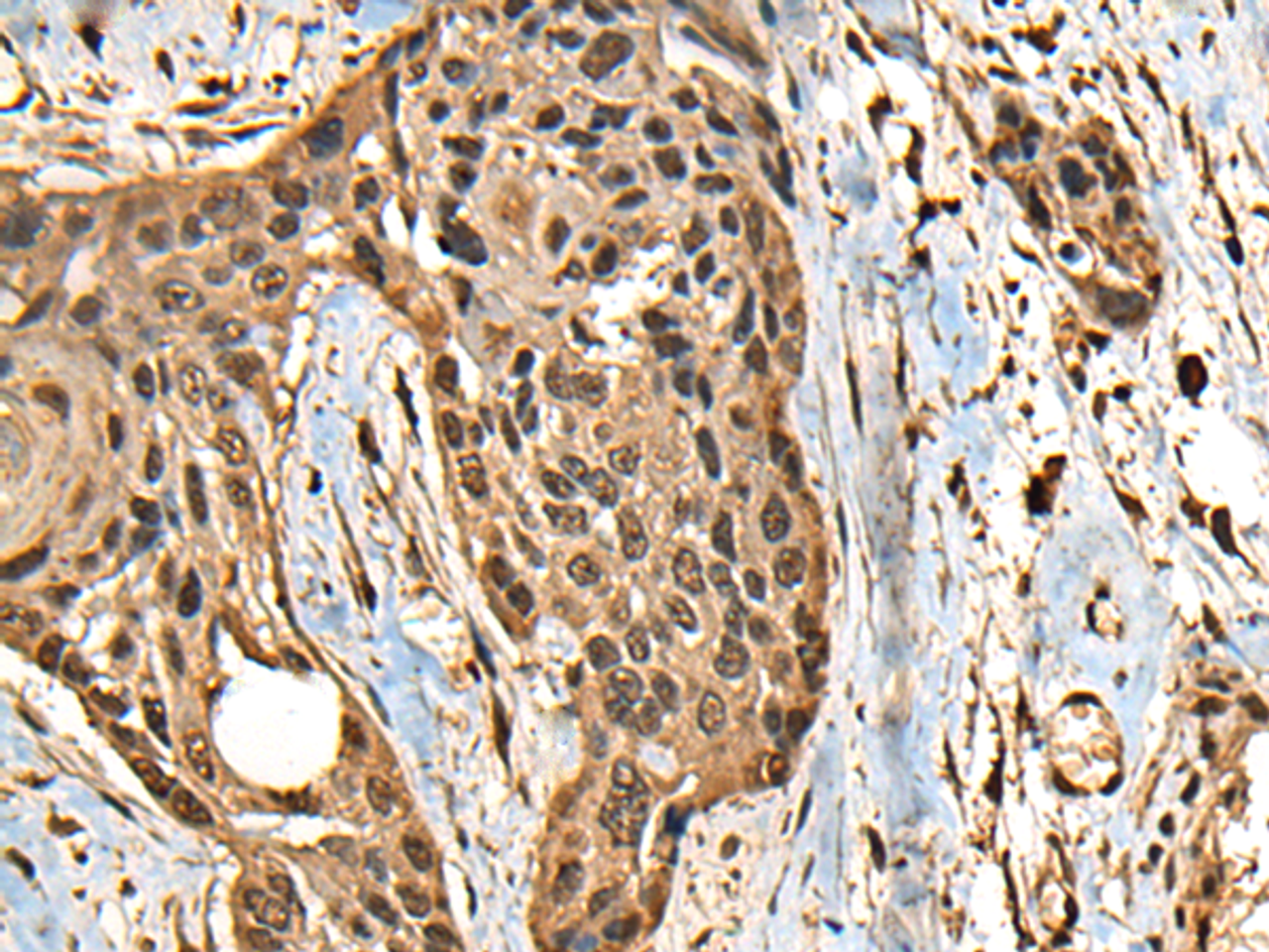 Immunohistochemistry of paraffin-embedded Human esophagus cancer tissue  using CCDC113 Polyclonal Antibody at dilution of 1:65(×200)