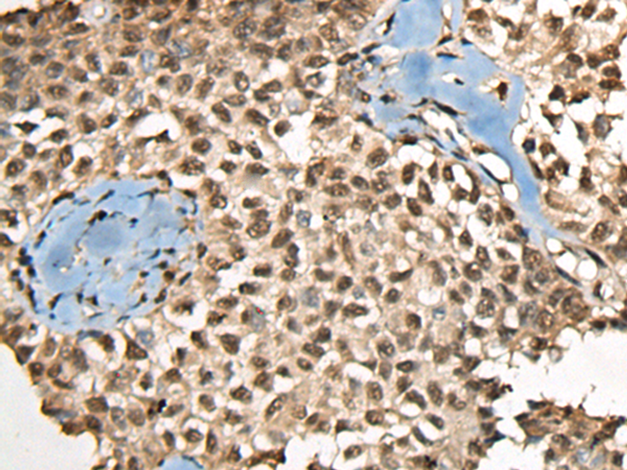 Immunohistochemistry of paraffin-embedded Human ovarian cancer tissue  using CCDC12 Polyclonal Antibody at dilution of 1:60(×200)