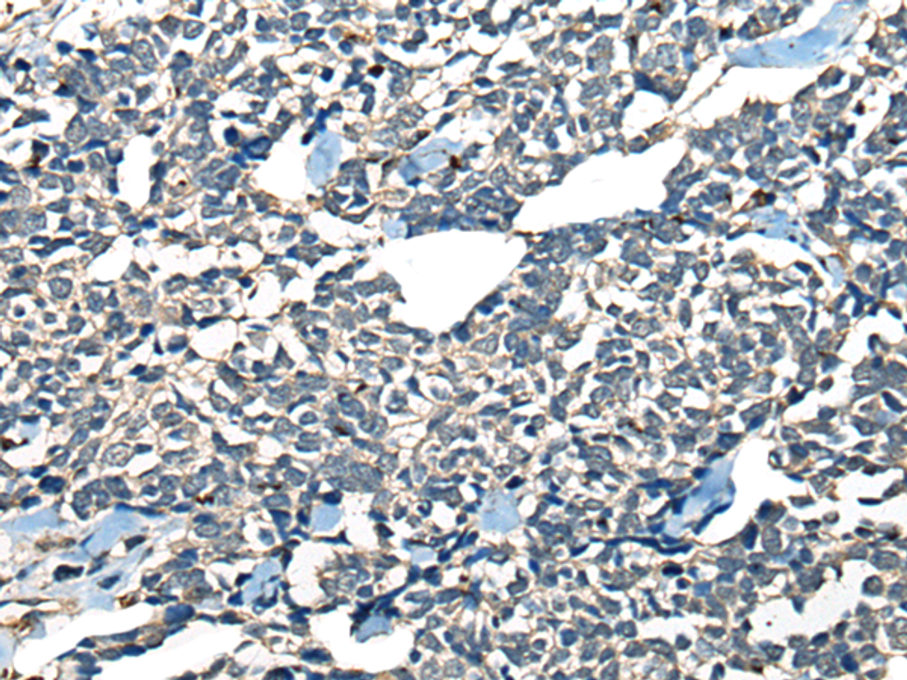 Immunohistochemistry of paraffin-embedded Human lung cancer tissue  using CDADC1 Polyclonal Antibody at dilution of 1:60(×200)