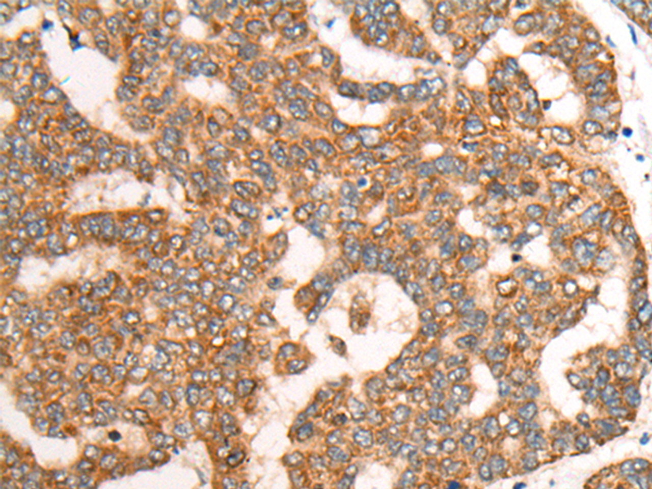 Immunohistochemistry of paraffin-embedded Human liver cancer tissue  using CDON Polyclonal Antibody at dilution of 1:65(×200)