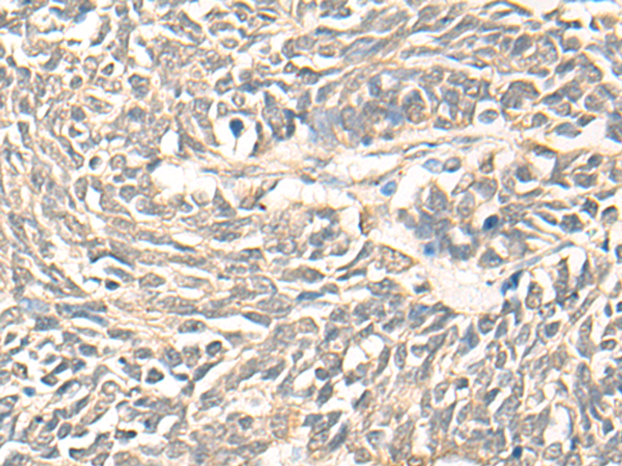 Immunohistochemistry of paraffin-embedded Human lung cancer tissue  using DMC1 Polyclonal Antibody at dilution of 1:30(×200)