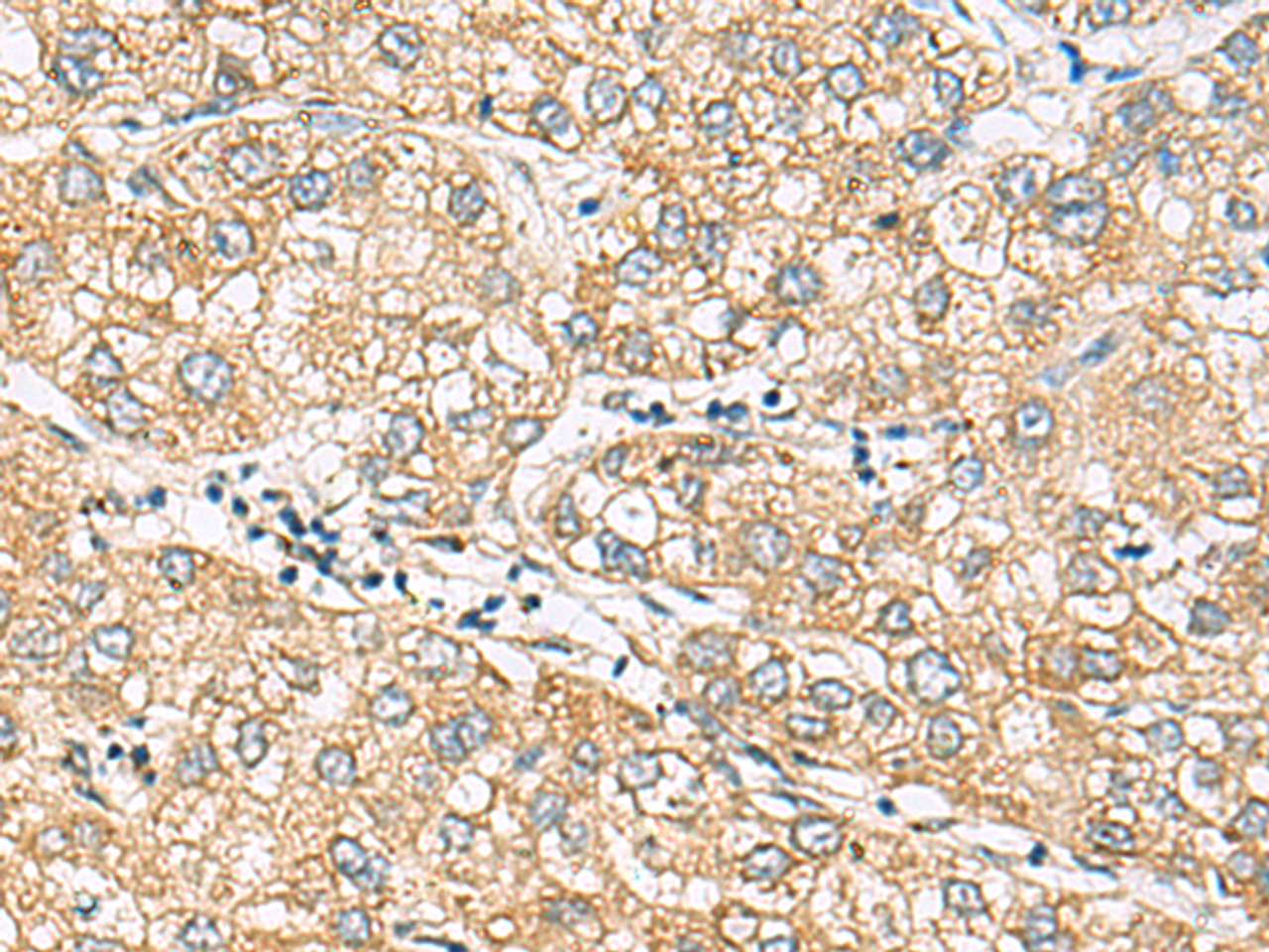 Immunohistochemistry of paraffin-embedded Human liver cancer tissue  using DACT3 Polyclonal Antibody at dilution of 1:70(×200)