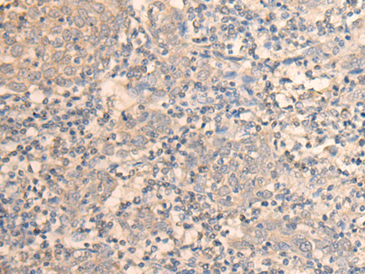 Immunohistochemistry of paraffin-embedded Human cervical cancer tissue  using DAZ1 Polyclonal Antibody at dilution of 1:55(×200)