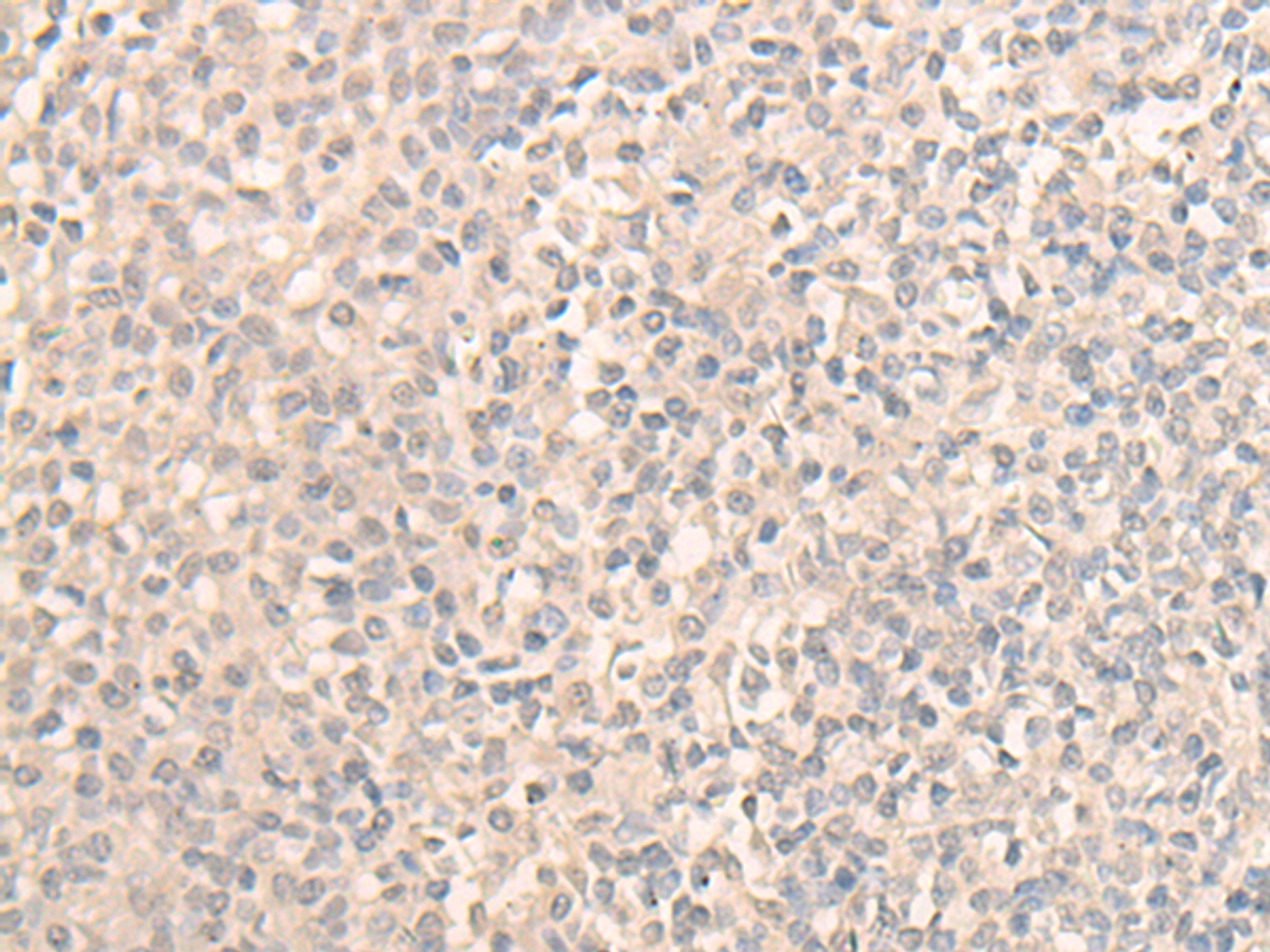 Immunohistochemistry of paraffin-embedded Human tonsil tissue  using DDX59 Polyclonal Antibody at dilution of 1:30(×200)