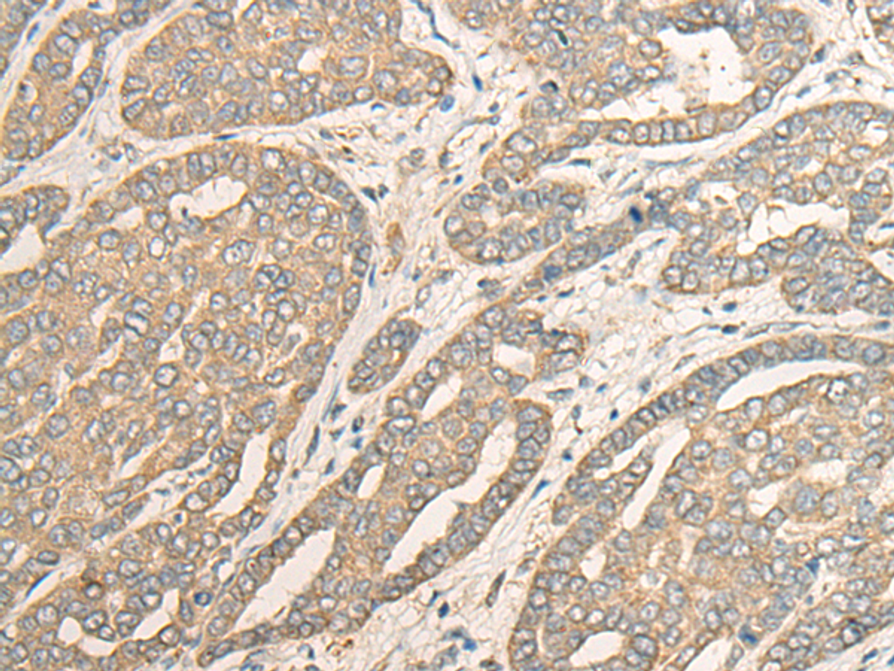 Immunohistochemistry of paraffin-embedded Human liver cancer tissue  using MYOZ2 Polyclonal Antibody at dilution of 1:40(×200)