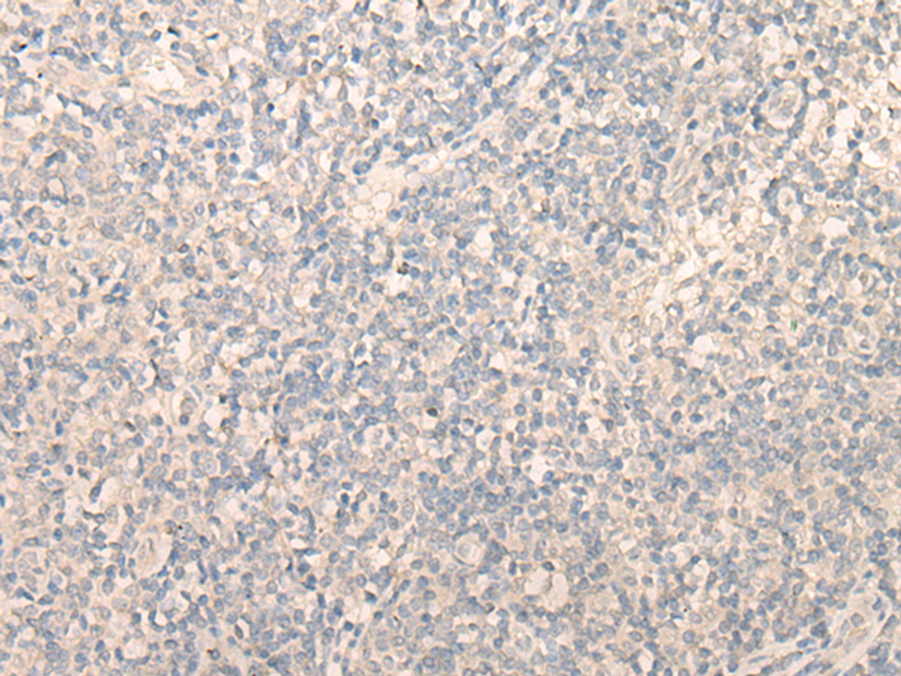Immunohistochemistry of paraffin-embedded Human tonsil tissue  using PITPNB Polyclonal Antibody at dilution of 1:25(×200)