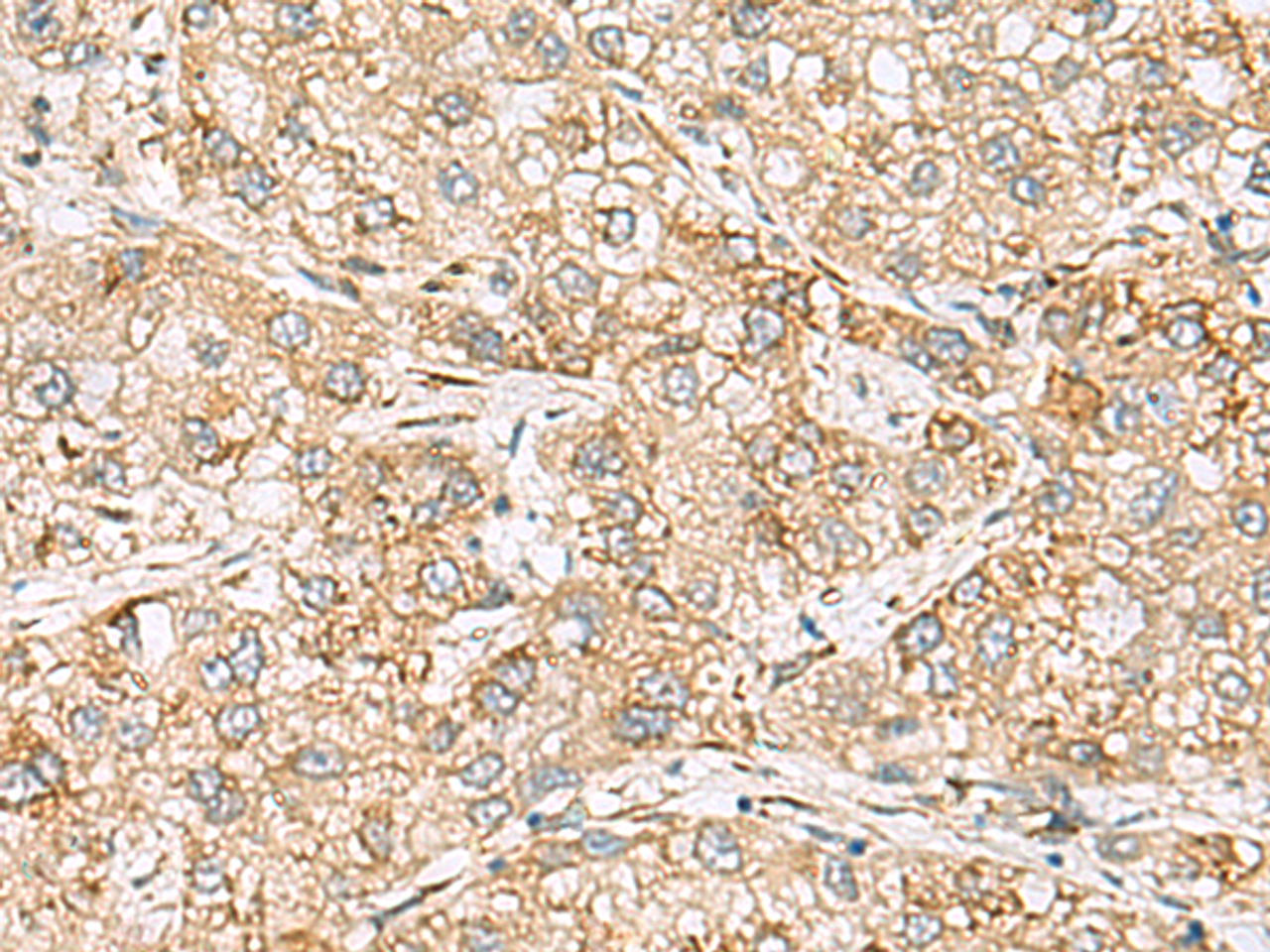 Immunohistochemistry of paraffin-embedded Human liver cancer tissue  using SH3GL2 Polyclonal Antibody at dilution of 1:80(×200)