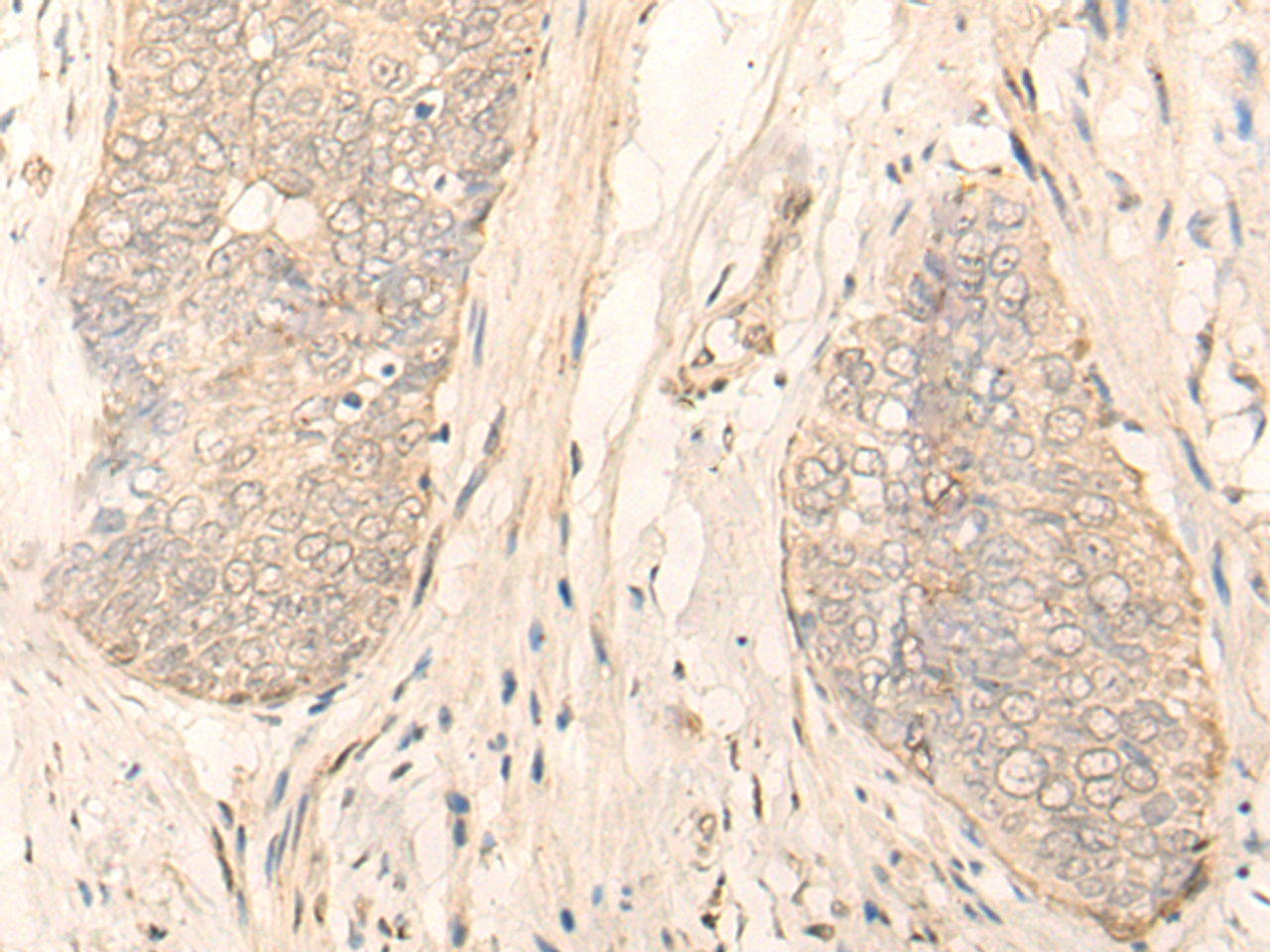 Immunohistochemistry of paraffin-embedded Human esophagus cancer tissue  using GK5 Polyclonal Antibody at dilution of 1:35(×200)