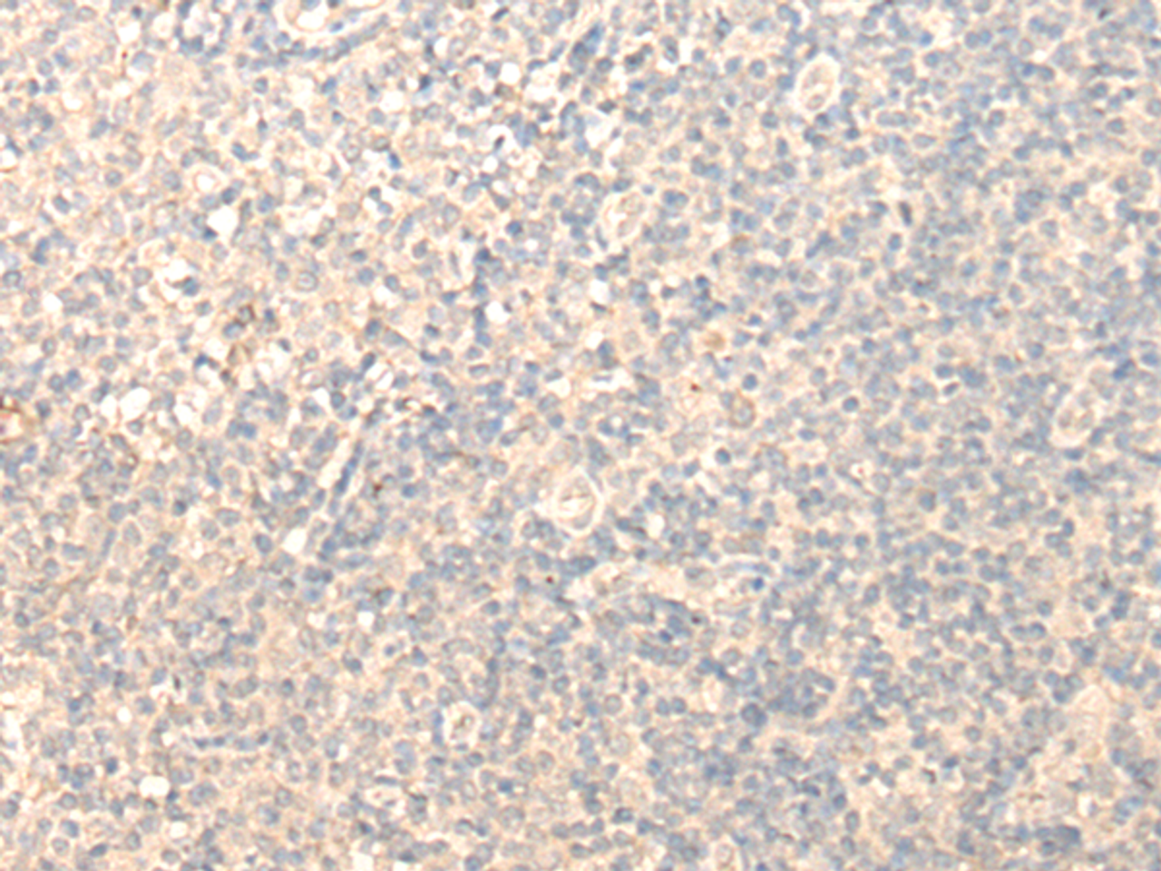 Immunohistochemistry of paraffin-embedded Human tonsil tissue  using MRPL1 Polyclonal Antibody at dilution of 1:25(×200)