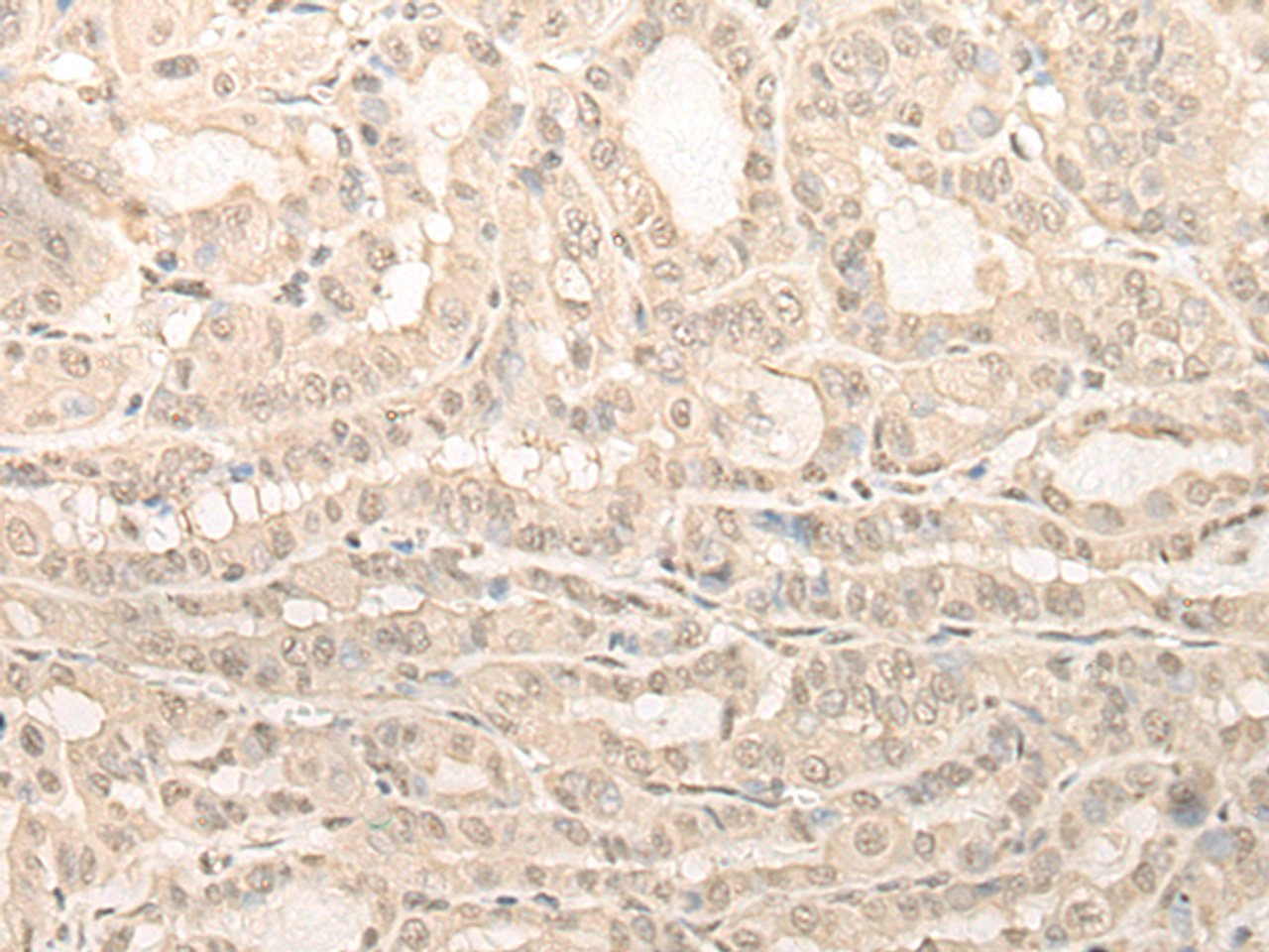 Immunohistochemistry of paraffin-embedded Human thyroid cancer tissue  using UBXN1 Polyclonal Antibody at dilution of 1:35(×200)