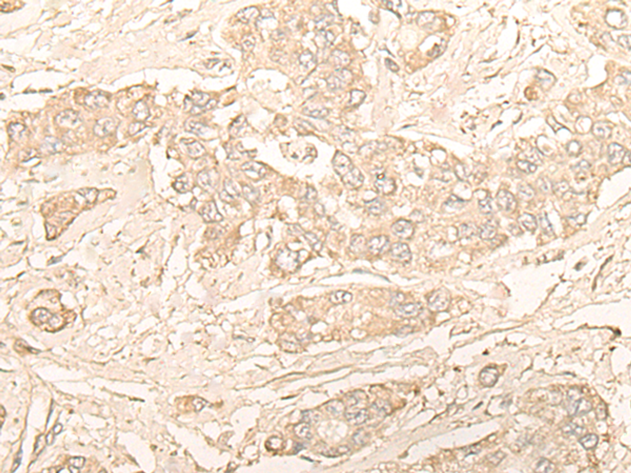 Immunohistochemistry of paraffin-embedded Human liver cancer tissue  using DIMT1 Polyclonal Antibody at dilution of 1:30(×200)