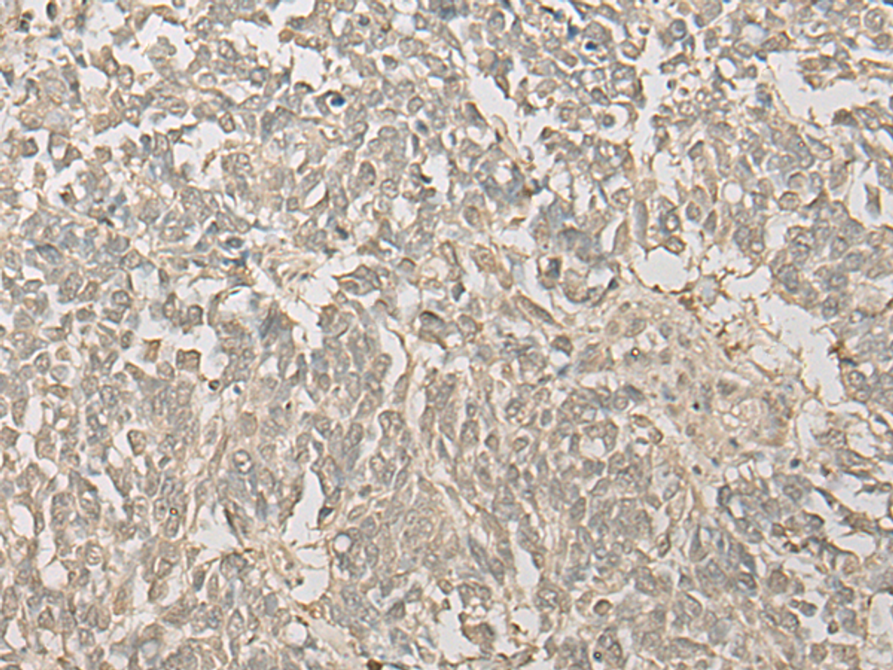 Immunohistochemistry of paraffin-embedded Human lung cancer tissue  using FYTTD1 Polyclonal Antibody at dilution of 1:30(×200)