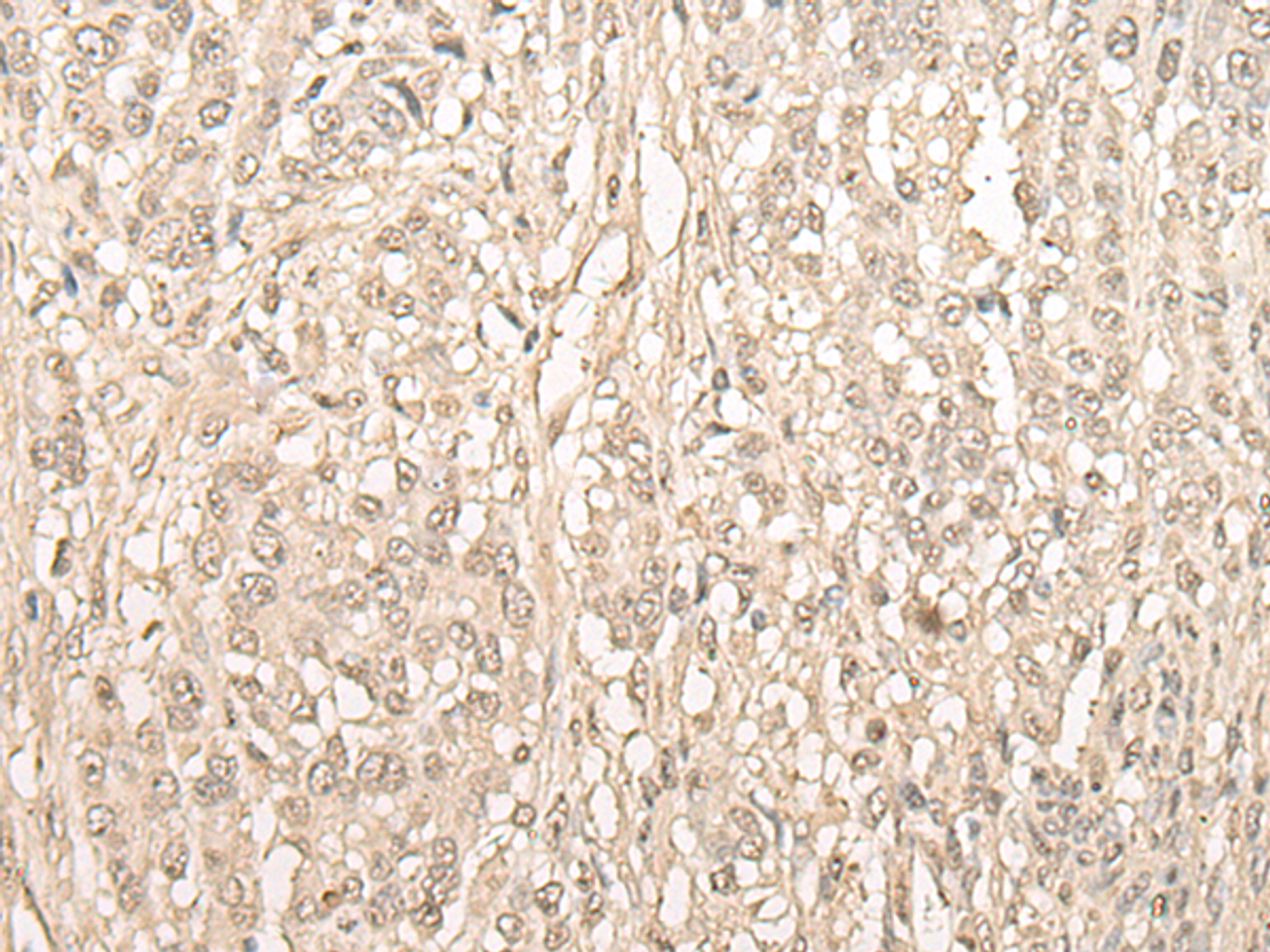 Immunohistochemistry of paraffin-embedded Human ovarian cancer tissue  using FYTTD1 Polyclonal Antibody at dilution of 1:30(×200)