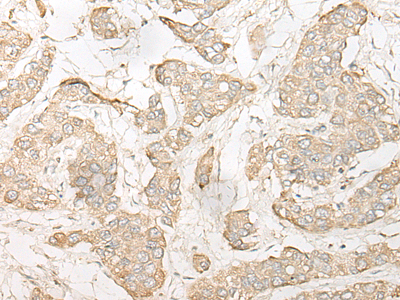 Immunohistochemistry of paraffin-embedded Human liver cancer tissue  using DHRS7 Polyclonal Antibody at dilution of 1:30(×200)