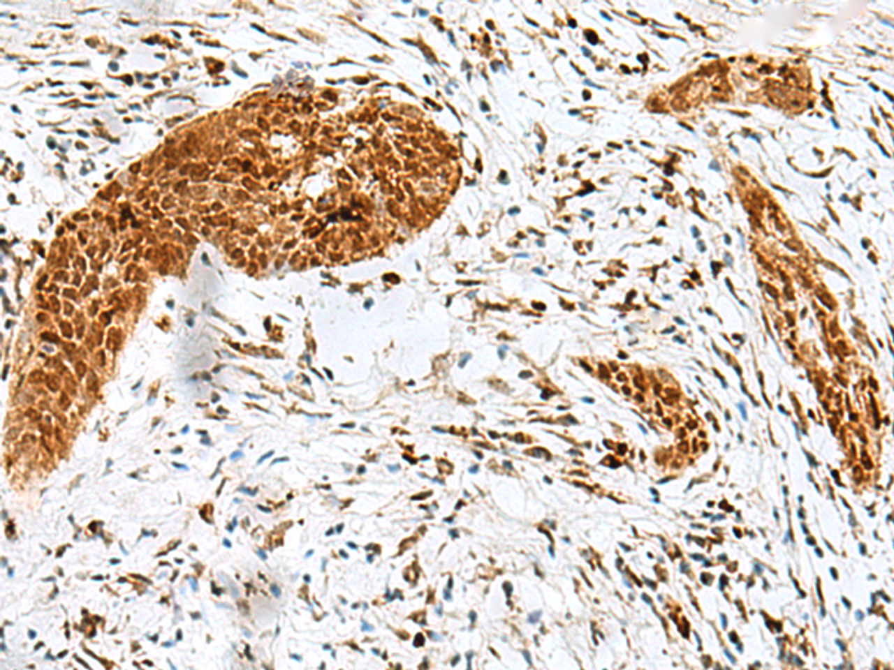 Immunohistochemistry of paraffin-embedded Human esophagus cancer tissue  using HMG20A Polyclonal Antibody at dilution of 1:25(×200)