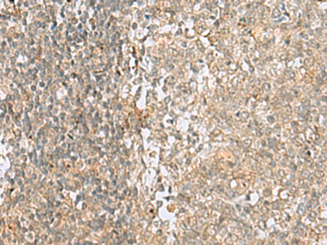 Immunohistochemistry of paraffin-embedded Human tonsil tissue  using HMG20A Polyclonal Antibody at dilution of 1:25(×200)