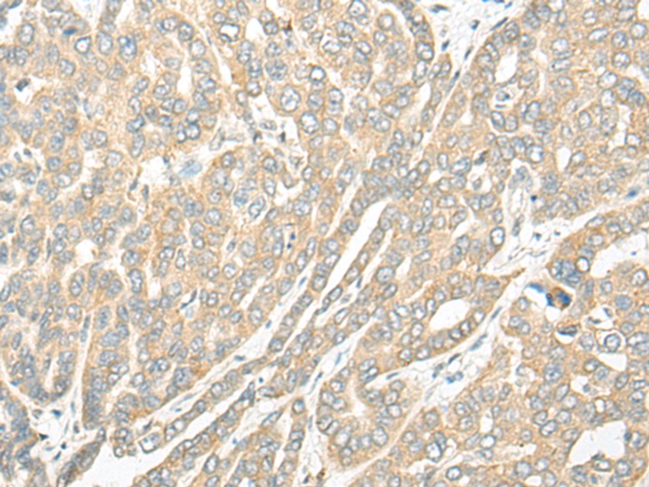 Immunohistochemistry of paraffin-embedded Human liver cancer tissue  using ROM1 Polyclonal Antibody at dilution of 1:25(×200)