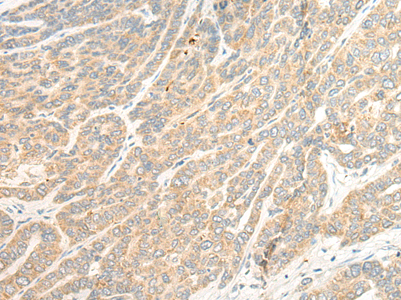 Immunohistochemistry of paraffin-embedded Human liver cancer tissue  using TTC4 Polyclonal Antibody at dilution of 1:45(×200)