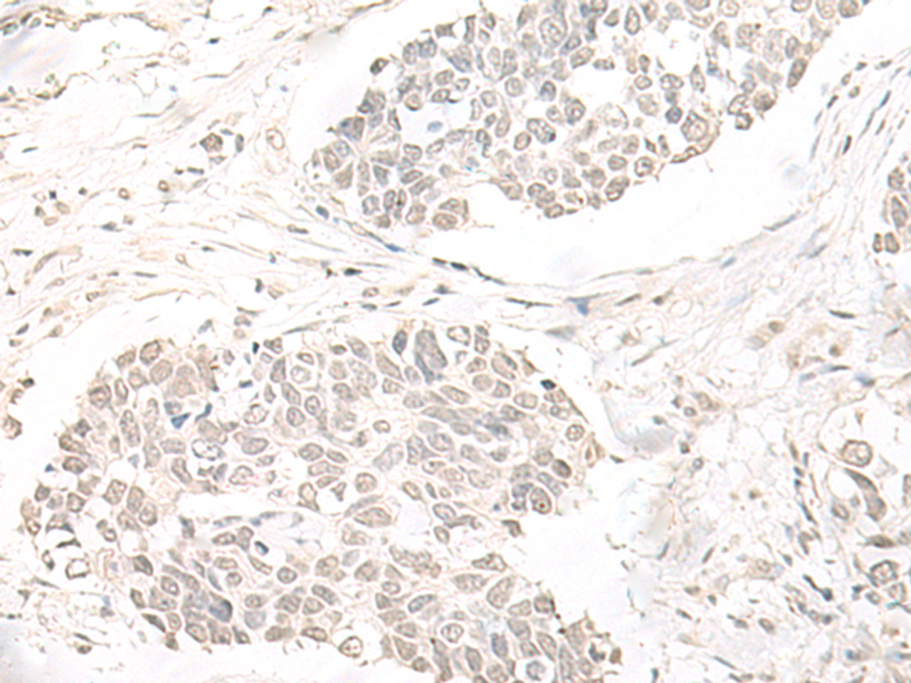 Immunohistochemistry of paraffin-embedded Human lung cancer tissue  using ILKAP Polyclonal Antibody at dilution of 1:50(×200)