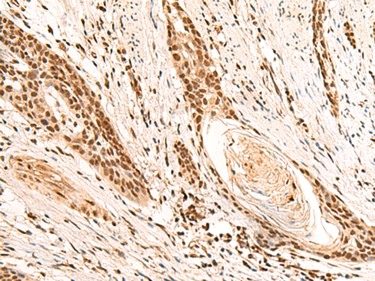 Immunohistochemistry of paraffin-embedded Human esophagus cancer tissue  using RMND5B Polyclonal Antibody at dilution of 1:50(×200)