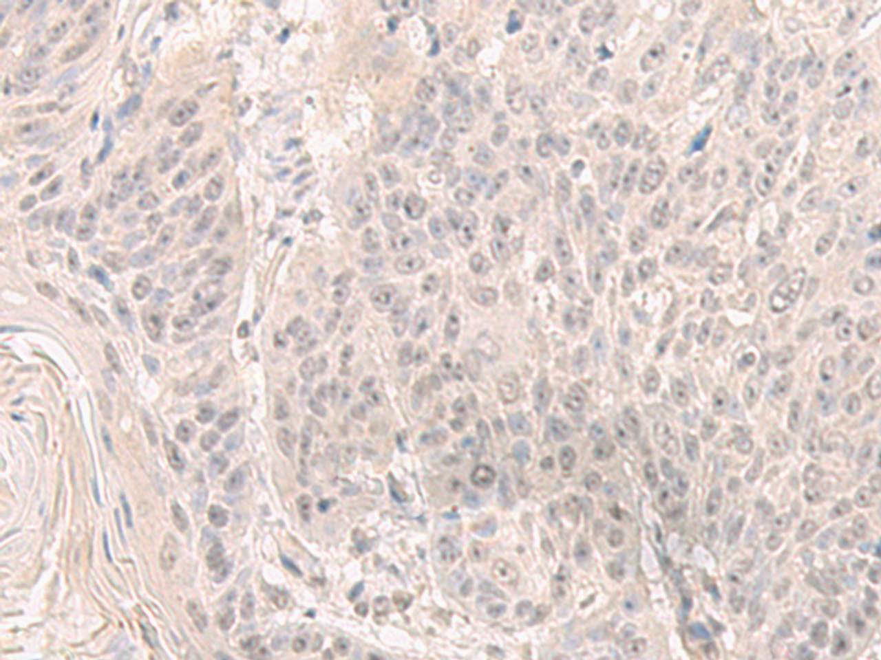 Immunohistochemistry of paraffin-embedded Human esophagus cancer tissue  using HENMT1 Polyclonal Antibody at dilution of 1:30(×200)