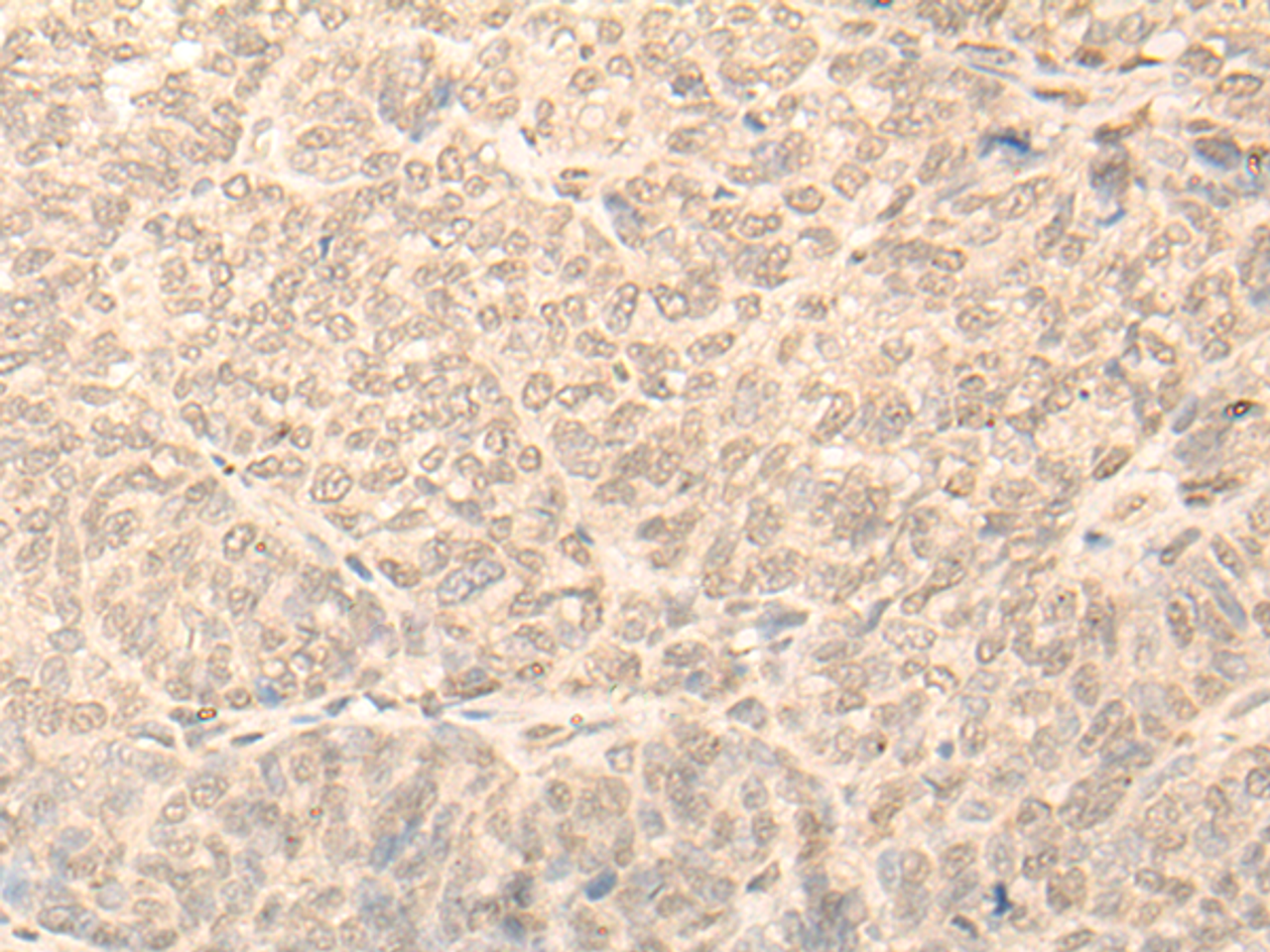 Immunohistochemistry of paraffin-embedded Human ovarian cancer tissue  using NARF Polyclonal Antibody at dilution of 1:45(×200)