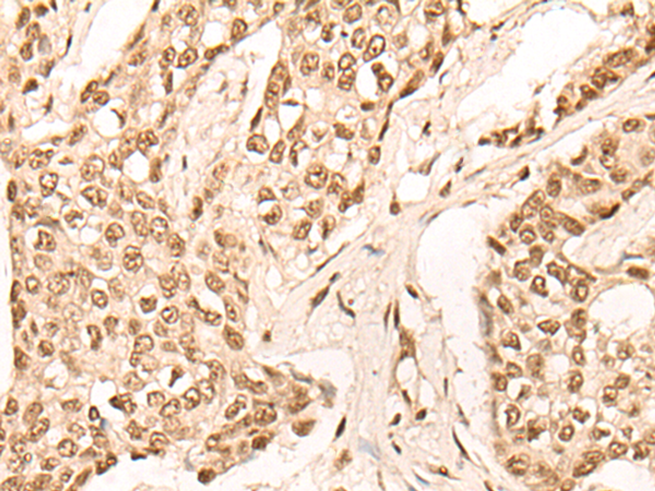 Immunohistochemistry of paraffin-embedded Human breast cancer tissue  using EIF4A3 Polyclonal Antibody at dilution of 1:45(×200)