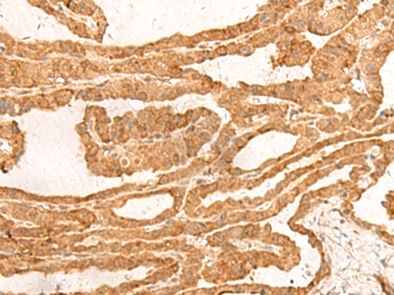 Immunohistochemistry of paraffin-embedded Human thyroid cancer tissue  using ZBTB8A Polyclonal Antibody at dilution of 1:100(×200)