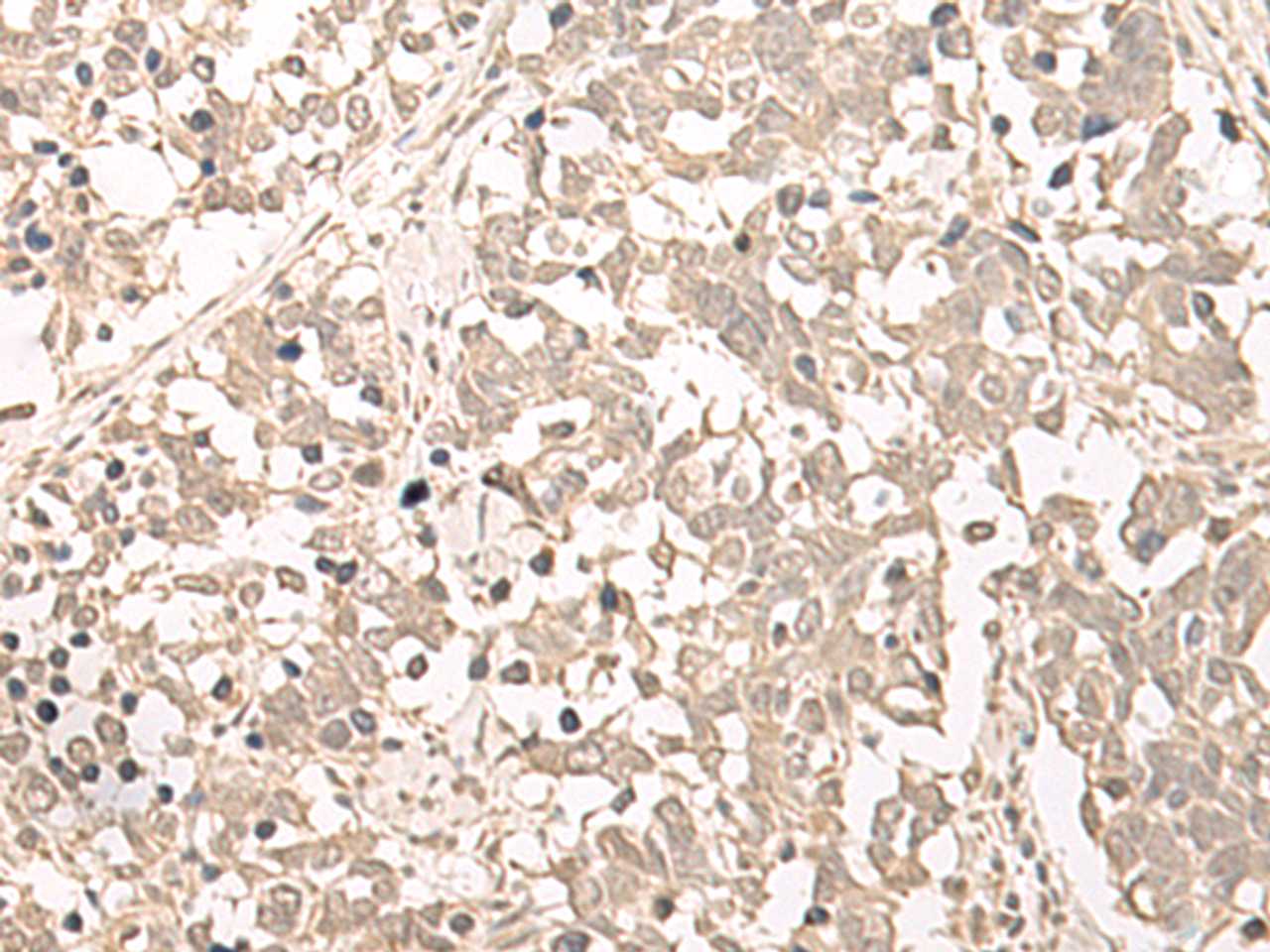 Immunohistochemistry of paraffin-embedded Human lung cancer tissue  using RRP1 Polyclonal Antibody at dilution of 1:45(×200)