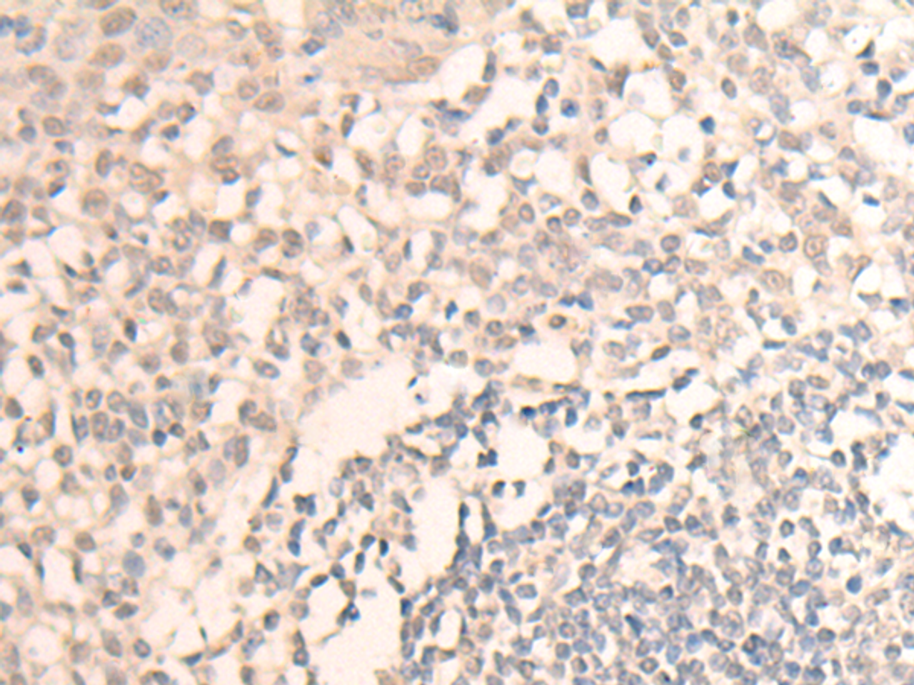 Immunohistochemistry of paraffin-embedded Human tonsil tissue  using MLLT6 Polyclonal Antibody at dilution of 1:40(×200)