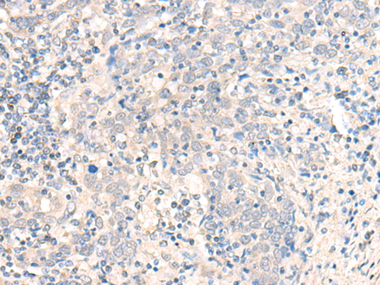 Immunohistochemistry of paraffin-embedded Human cervical cancer tissue  using CCDC47 Polyclonal Antibody at dilution of 1:25(×200)