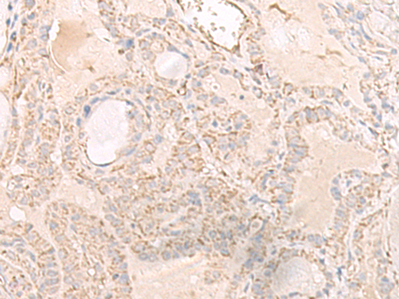 Immunohistochemistry of paraffin-embedded Human thyroid cancer tissue  using IGHA1 Polyclonal Antibody at dilution of 1:65(×200)