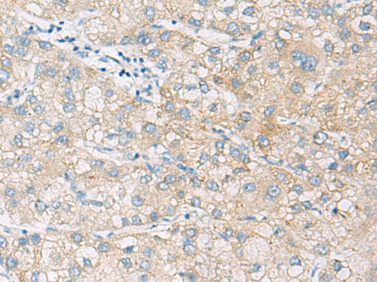 Immunohistochemistry of paraffin-embedded Human liver cancer tissue  using NCOA4 Polyclonal Antibody at dilution of 1:130(×200)