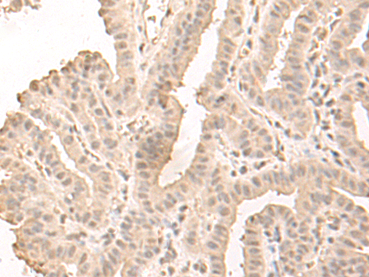 Immunohistochemistry of paraffin-embedded Human thyroid cancer tissue  using SAP130 Polyclonal Antibody at dilution of 1:50(×200)