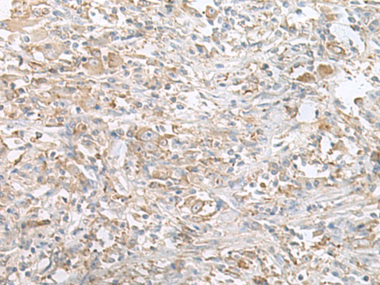 Immunohistochemistry of paraffin-embedded Human liver cancer tissue  using PFKM Polyclonal Antibody at dilution of 1:60(×200)
