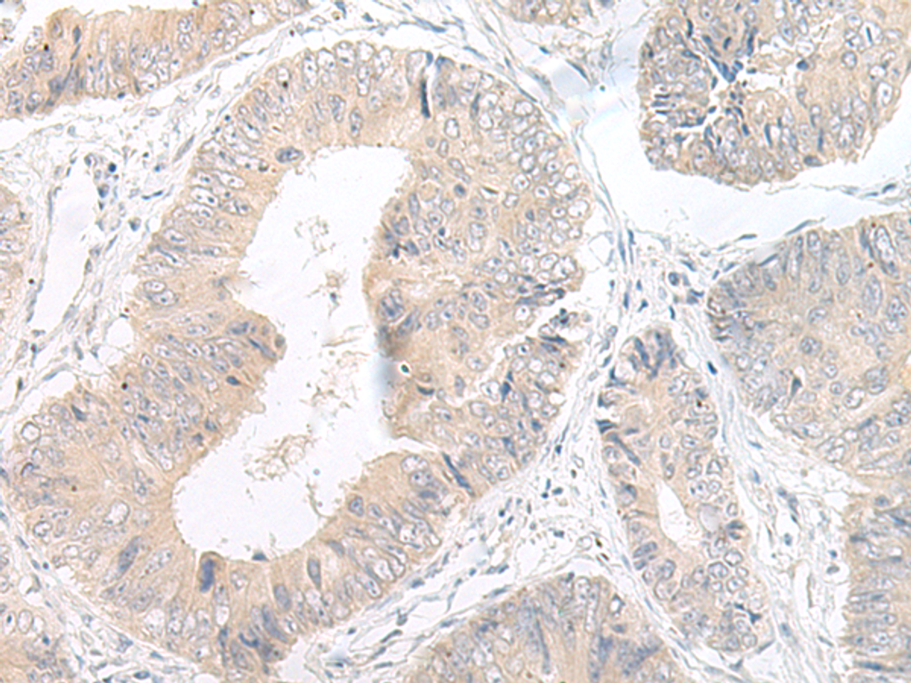 Immunohistochemistry of paraffin-embedded Human colorectal cancer tissue  using LYRM2 Polyclonal Antibody at dilution of 1:50(×200)