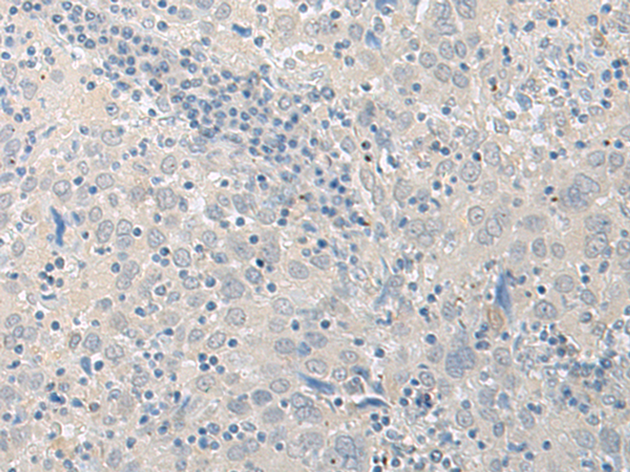 Immunohistochemistry of paraffin-embedded Human cervical cancer tissue  using LYRM2 Polyclonal Antibody at dilution of 1:50(×200)