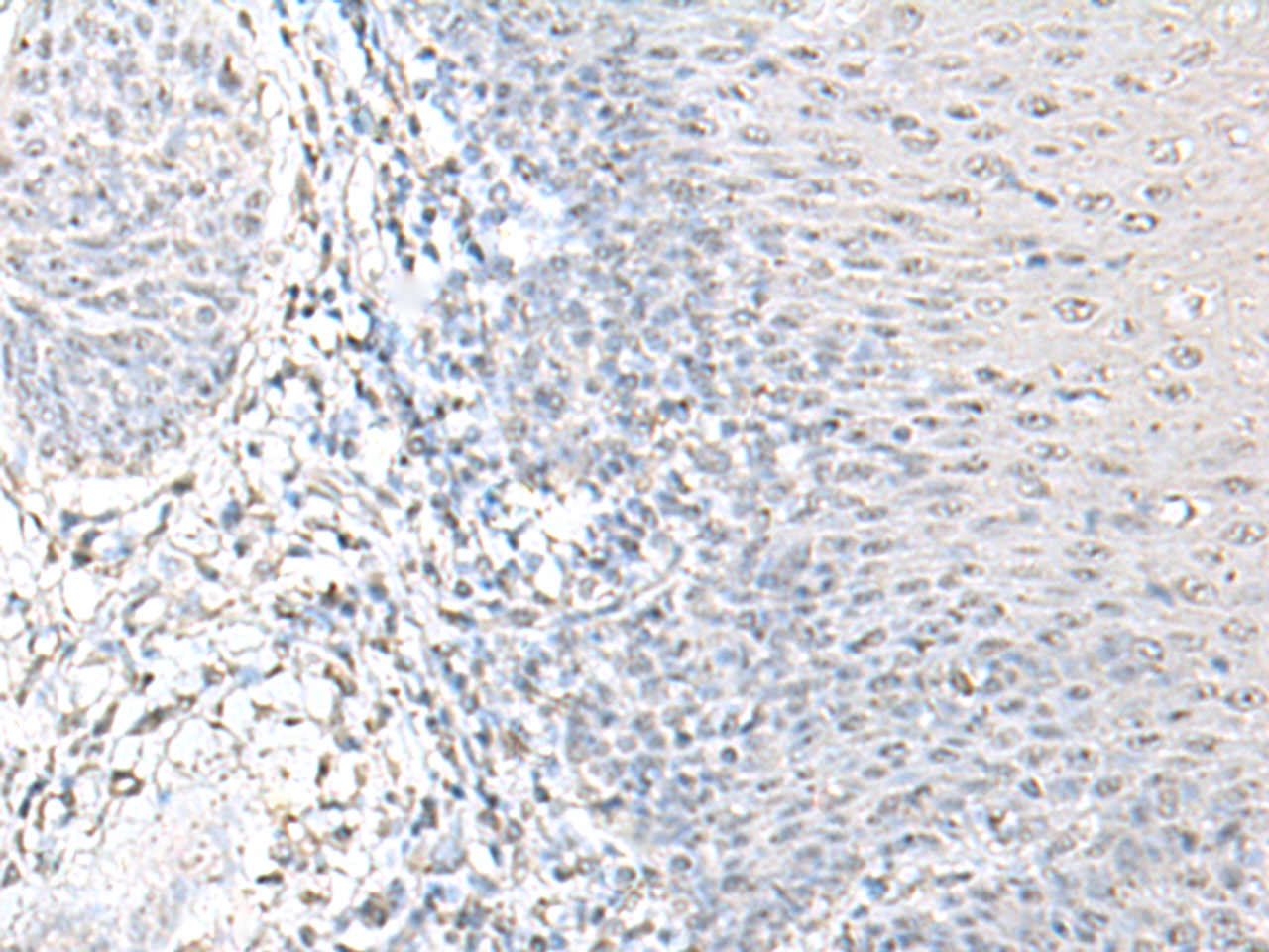Immunohistochemistry of paraffin-embedded Human esophagus cancer tissue  using EPM2A Polyclonal Antibody at dilution of 1:55(×200)