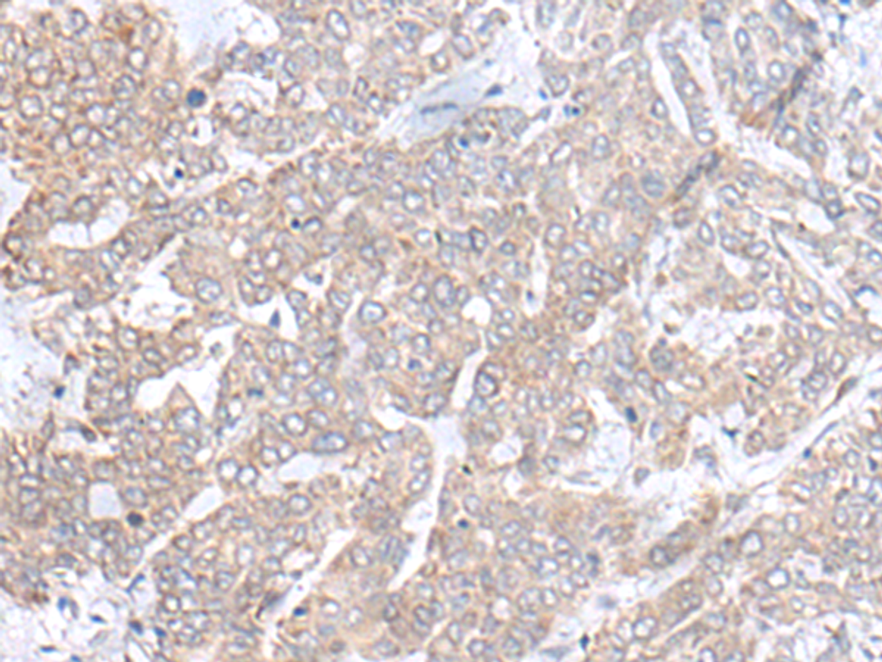 Immunohistochemistry of paraffin-embedded Human liver cancer tissue  using PLGLB2 Polyclonal Antibody at dilution of 1:65(×200)