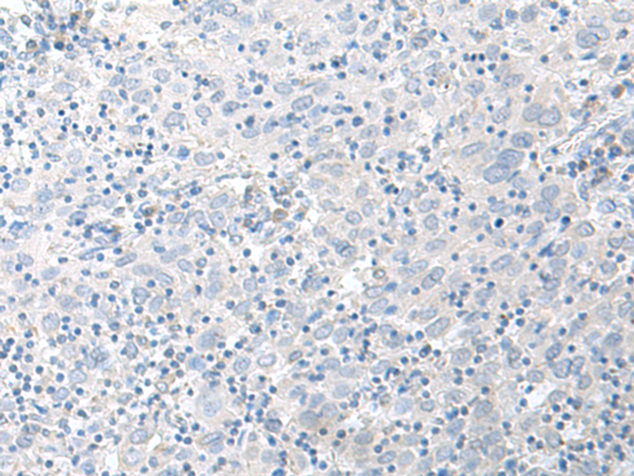 Immunohistochemistry of paraffin-embedded Human cervical cancer tissue  using STAU2 Polyclonal Antibody at dilution of 1:45(×200)