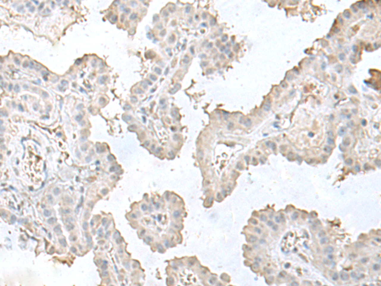 Immunohistochemistry of paraffin-embedded Human thyroid cancer tissue  using LSM10 Polyclonal Antibody at dilution of 1:50(×200)