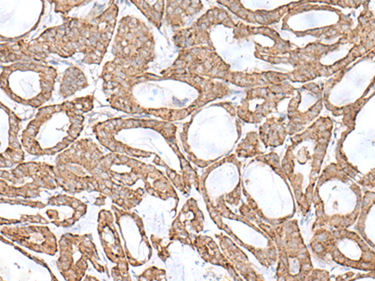 Immunohistochemistry of paraffin-embedded Human thyroid cancer tissue  using RNF111 Polyclonal Antibody at dilution of 1:50(×200)
